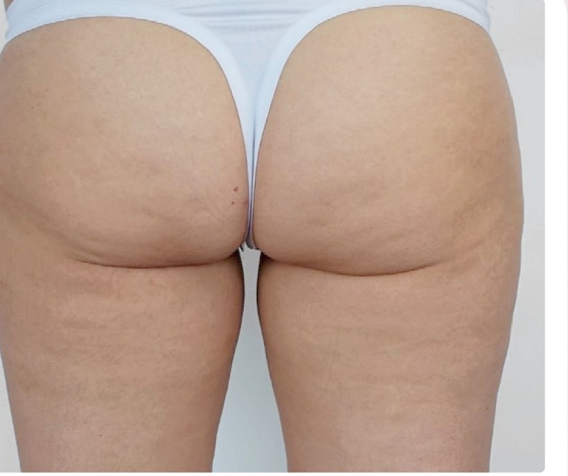 Après le protocole d'endermologie du visage à Laval