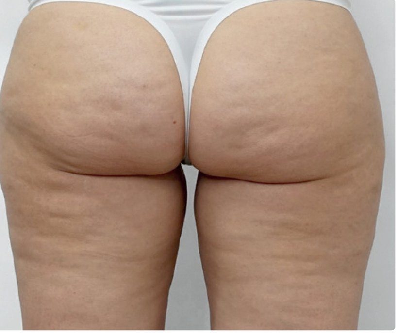 Avant le protocole d'endermologie du visage à Laval