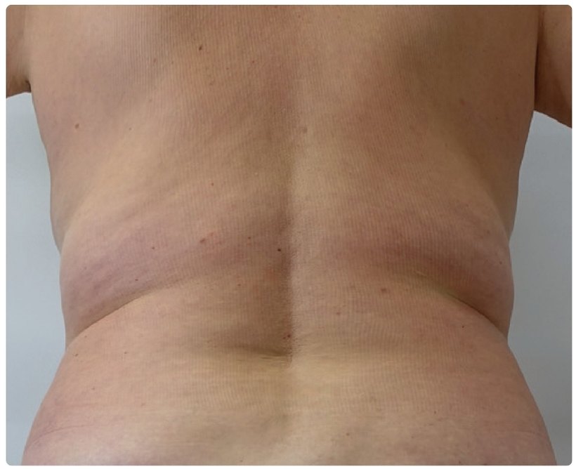 Avant/après endermologie du corps à Laval — −4,5 cm, 12 séances