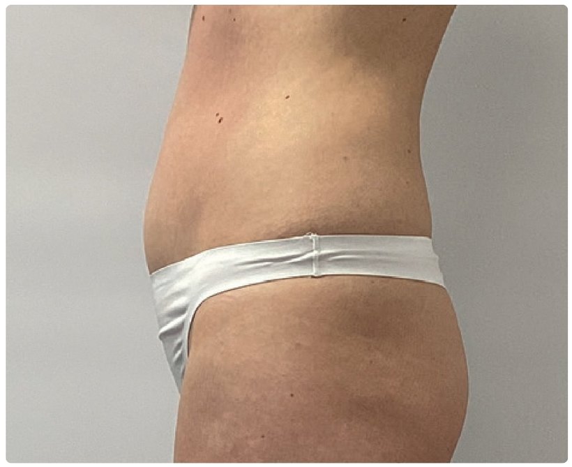 Avant/après endermologie du corps à Laval — −2,5 cm, 10 séances