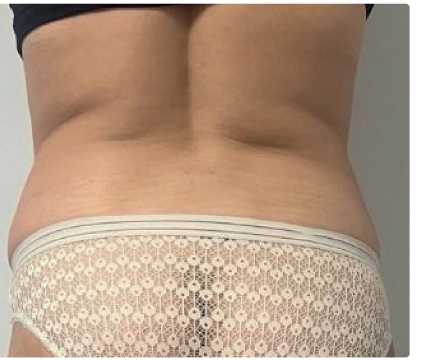 Avant/après endermologie du corps à Laval — −8 cm de tour de hanches, 8 séances