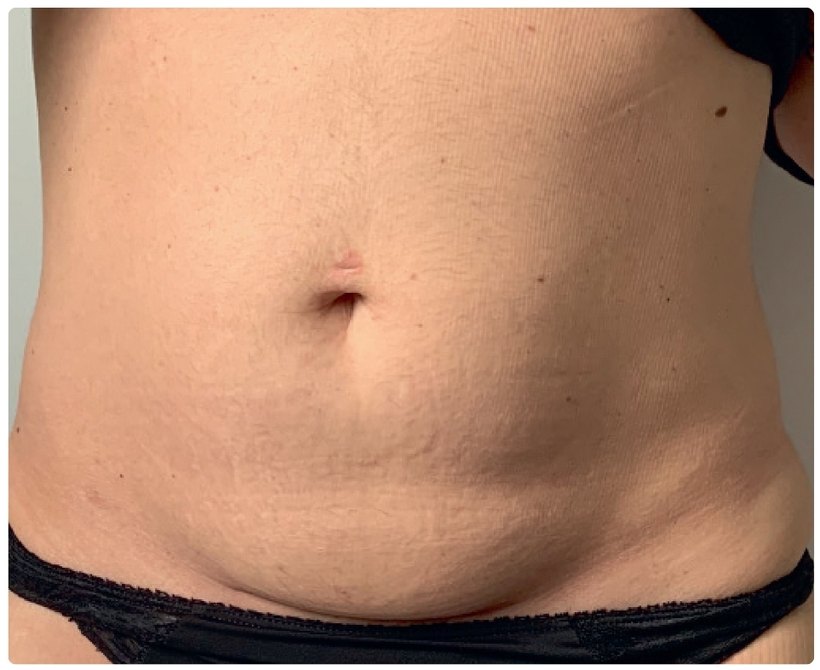 Avant/après endermologie du corps à Laval — 12 séances, corps sur-mesure