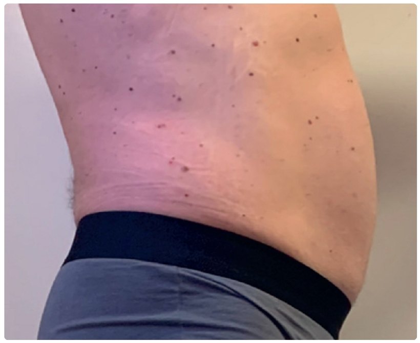 Avant/après endermologie du corps à Laval — −5,5 graisse viscérale, 6 séances