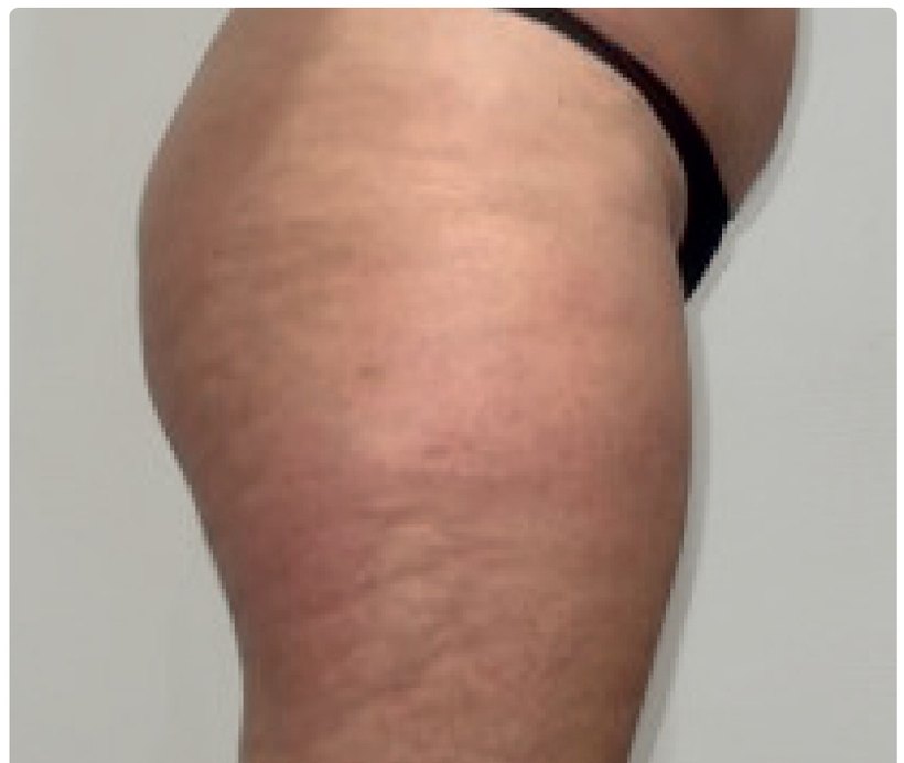 Avant/après endermologie du corps à Laval — 6 séances, 35 min