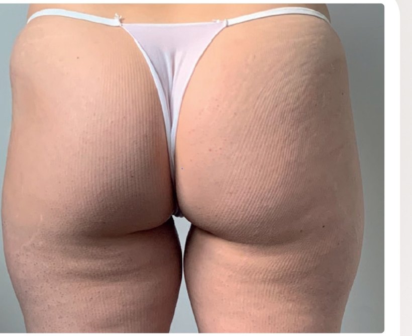 Avant/après endermologie du corps à Laval — −2,1 kg, 12 séances
