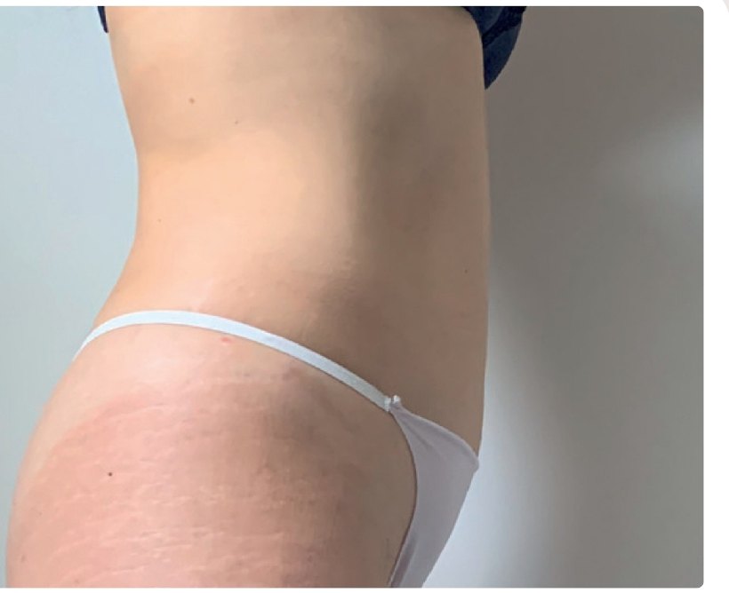 Avant/après endermologie du corps à Laval — −2,1 kg, 12 séances