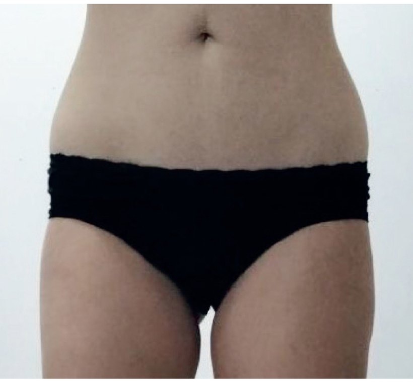 Avant/après endermologie du corps à Laval — −4,5 cm, 8 séances