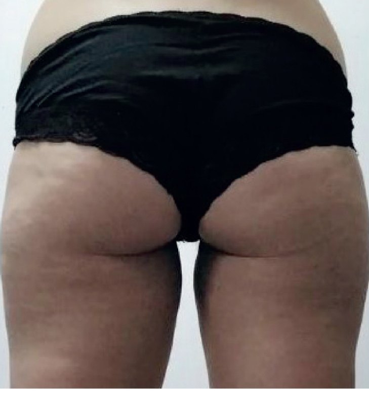 Avant/après endermologie du corps à Laval — −2,8 cm de tour de hanches, 8 séances