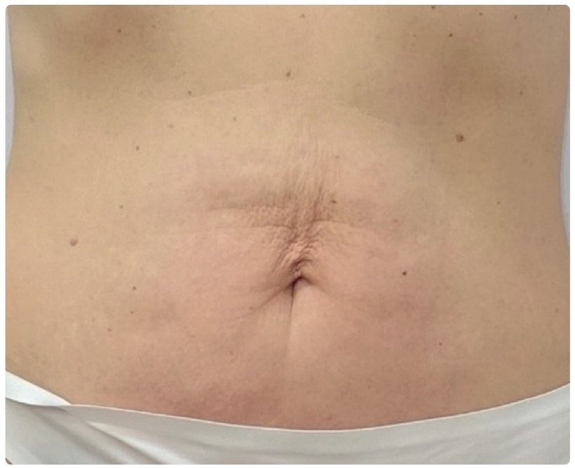 Avant/après endermologie du corps à Laval — −2,5 cm, 12 séances