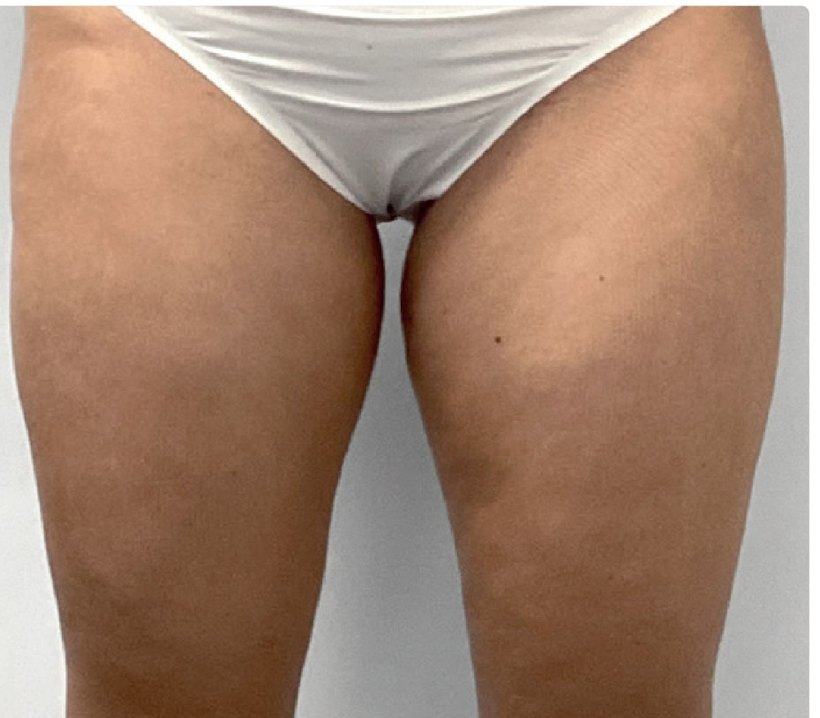 Avant/après endermologie du corps à Laval — −2 kg, 3 séances