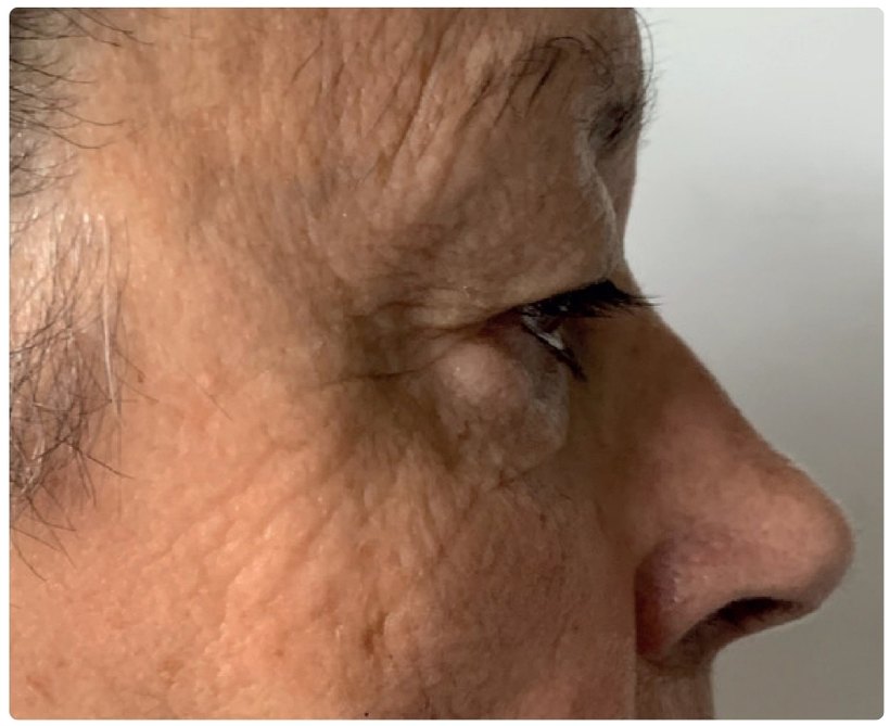 Avant/après endermologie du visage à Laval — 12 séances, anti-âge