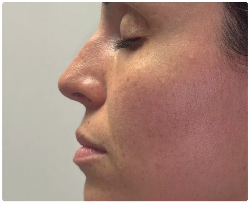 Avant/après endermologie du visage à Laval — ×2 d'éclat du teint, 2 séances