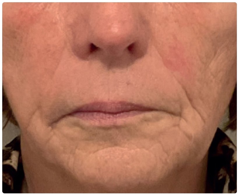 Avant/après endermologie du visage à Laval — 6 séances, anti-âge