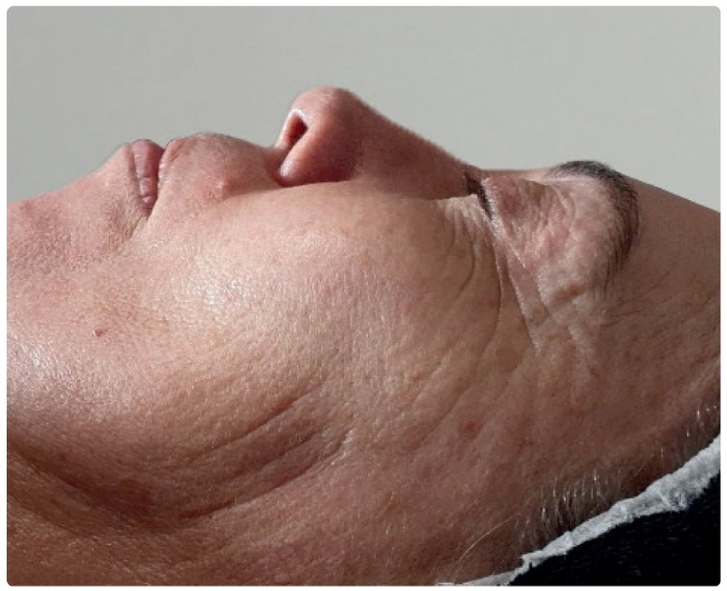 Avant/après endermologie du visage à Laval — 1 séance, anti-âge