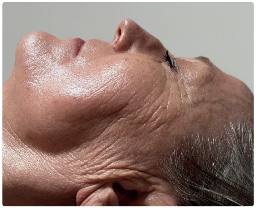 Avant/après endermologie du visage à Laval — 1 séance, anti-âge