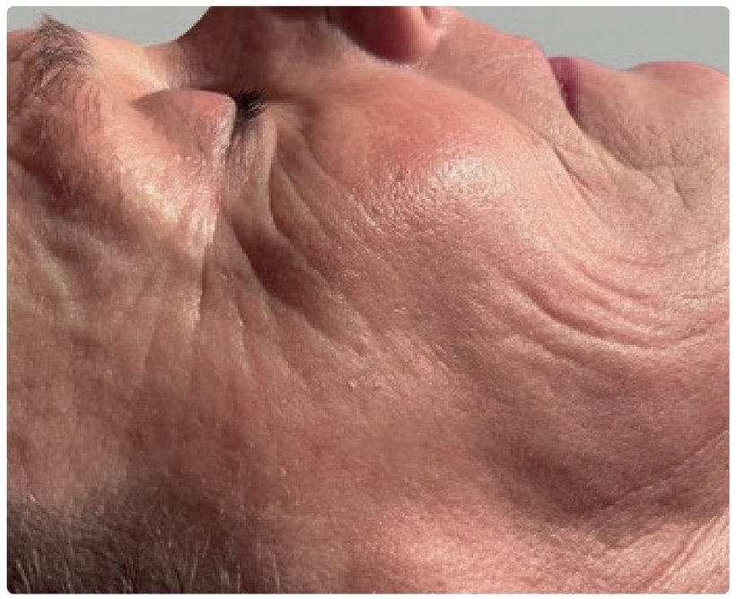 Après le protocole d'endermologie du visage à Laval