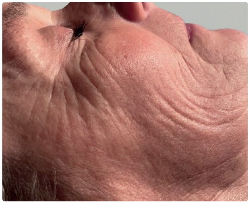 Avant le protocole d'endermologie du visage à Laval