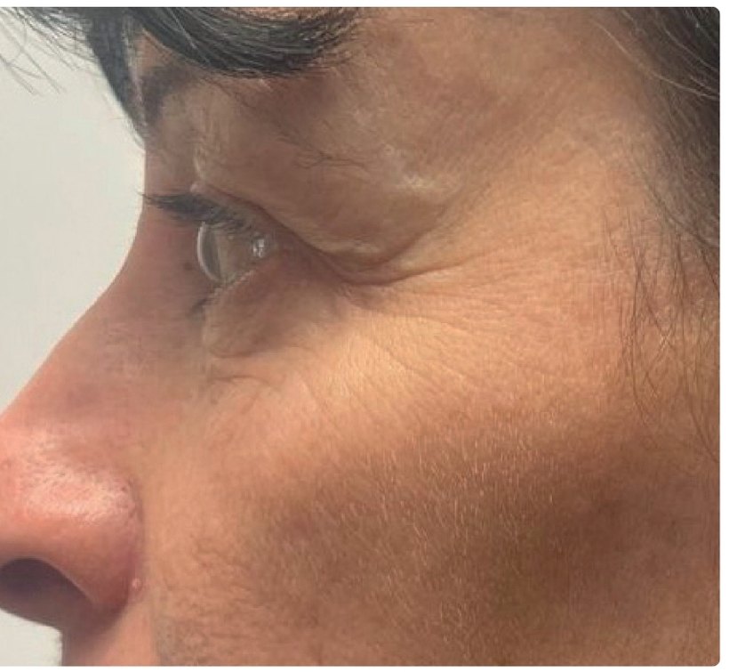 Avant/après endermologie du visage à Laval — 1 séance, anti-âge