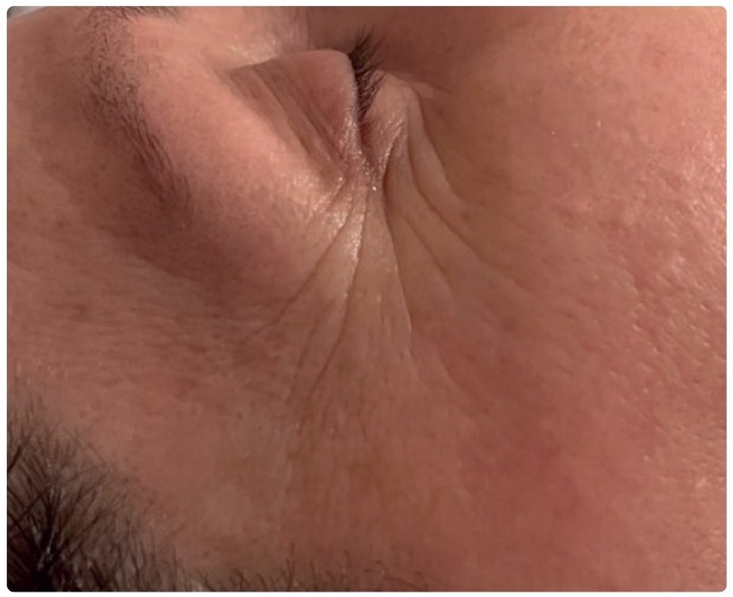 Avant/après endermologie du visage à Laval — 1 séance, anti-âge