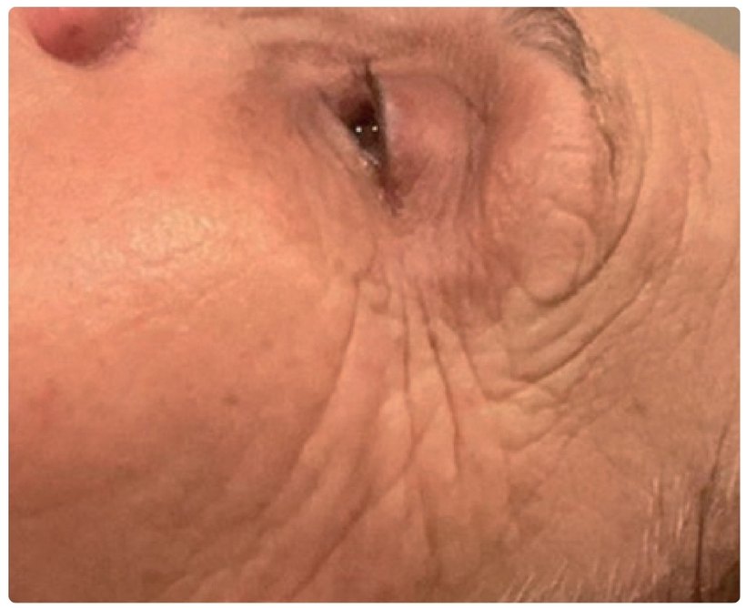 Avant/après endermologie du visage à Laval — 1 séance, anti-âge