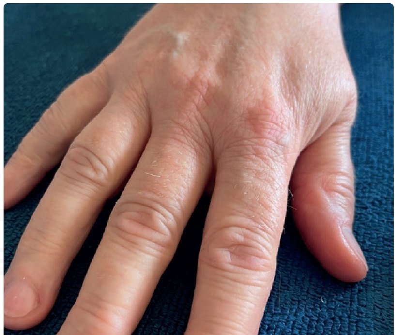 Avant/après endermologie du visage à Laval — 1 séance, 10 min